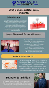 Bone Graft for Dental Implant