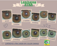 lumineyes laser eye color change surgery